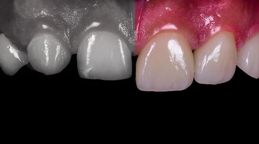 The Crafting and Fitting of EMAX Veneers