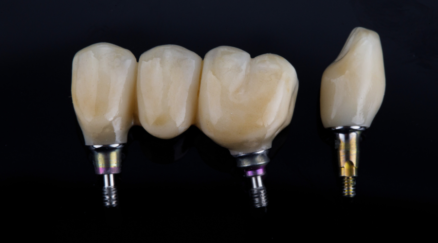 bridges, combien d'implants dentaires peut on poser en une seule fois.