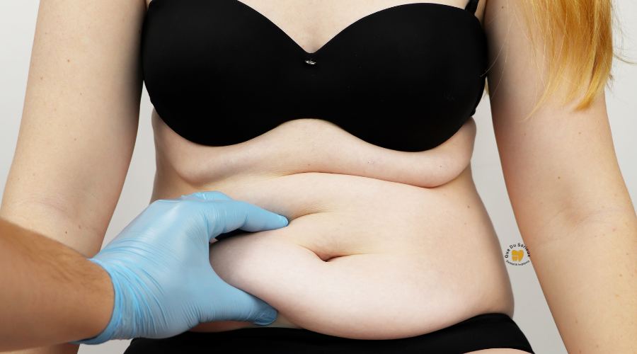 Who is abdominoplasty for?