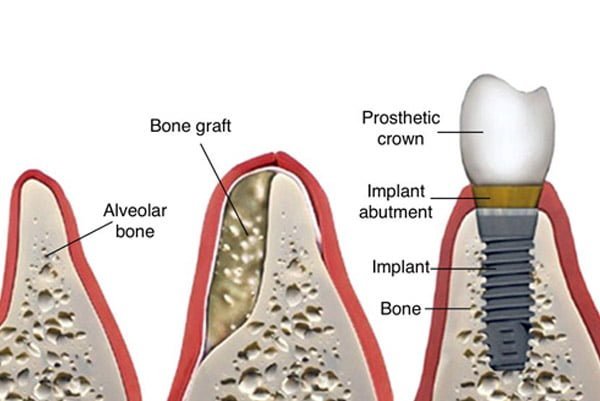 Qu'est-ce qu'un implant dentaire 