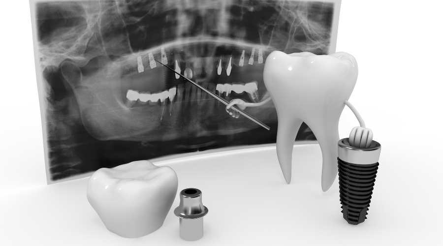 Photos Implant Dentaire Avant et Après